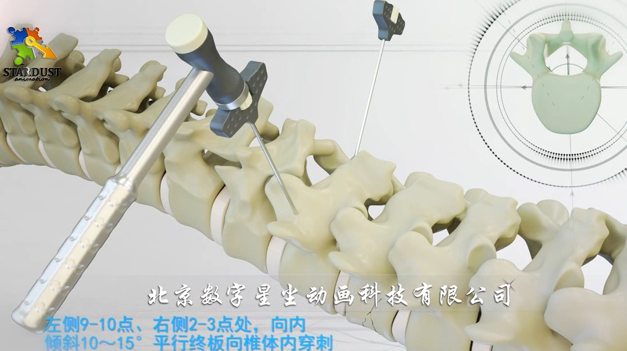 脊柱手术内固定器放置位置和角度三维动画